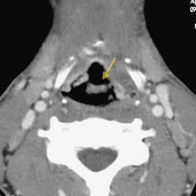 CT scan obtained at supraglottic and glottic level of the larynx.