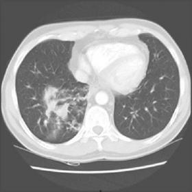 Thoracic CT after intravenous administration of contrast