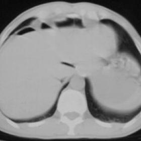 abdominal CT scans