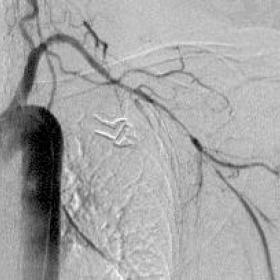 Angiography of aortic arch