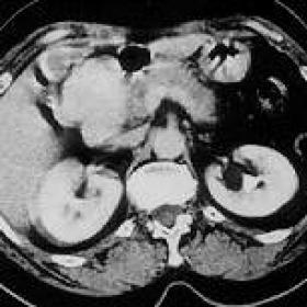 Abdominal CT images