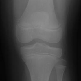 Pre-operative antero-posterior view of left knee