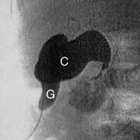 Peroperative retrograde cholangiography showing a choledocal cyst