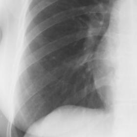 chest X-ray in follow up