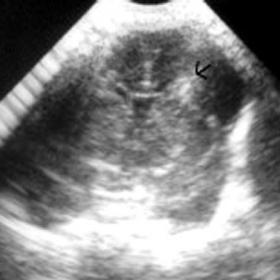 Initial transcranial US,1 week post birth.