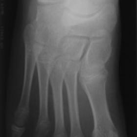 Antero-posterior radiograph right foot
