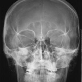 skull radiography on first evaluation