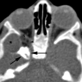 Axial unenhanced CT image