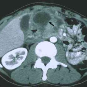 CT examination of the abdomen