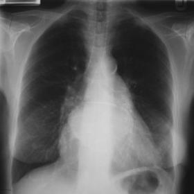 PA Chest Radiograph
