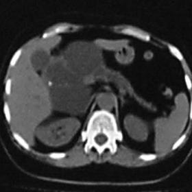 Serous cystadenoma of the pancreas