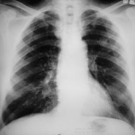 Chest x-ray, 9/8/93