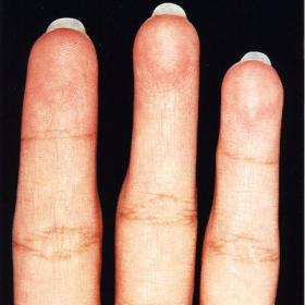 Picture of Patients Left hand
