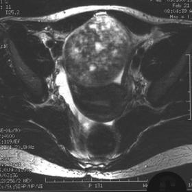 Axial T2-weighted image of the pelvis