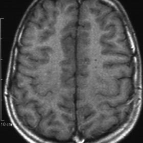 Virchow-Robin spaces on MR of Brain - T1 axial slice