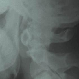 Lateral cervical plain radiograph.