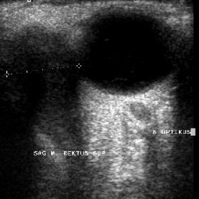 Orbital ultrasound