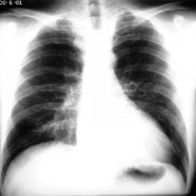 Frontal chest radiograph