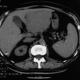 Primary hepatic lymphoma: spiral CT