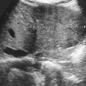 Ultrasound of the liver.