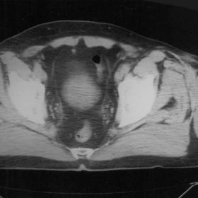 CT of the upper thigh.