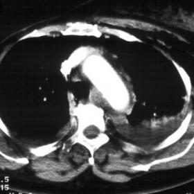 Spiral CT performed at admission for diagnosis