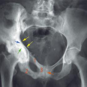 Paget's disease involving the pelvis; frontal X-ray of the pelvis.