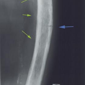Pagetic disease of the femur; pathological fracture