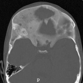 Polyostotic craniofacial fibrous dysplasia