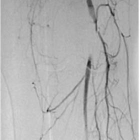 Arteriography of the popliteal artery
