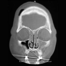 CT of sinuses and orbit