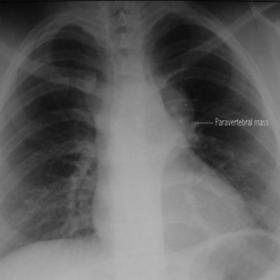 Chest x-ray