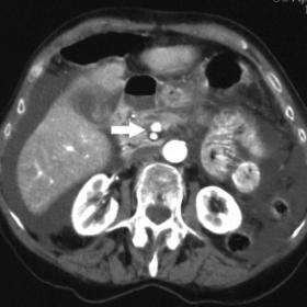 Contrast-enhanced axial CT scan of the abdomen