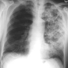 Presenting chest x-ray