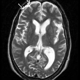 MRI in a patient with dementia, ataxia and incontinence