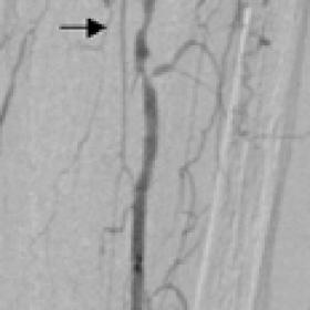 PTA and stent implantation into the interosseal artery