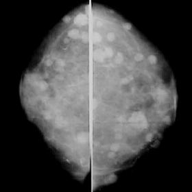 Craniocaudal view mammograms of breasts