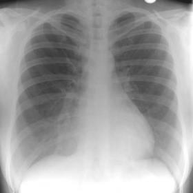 Postero-anterior and lateral chest x-rays