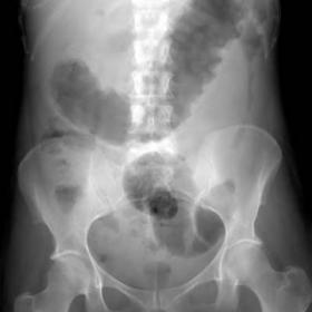Supine abdominal radiograph