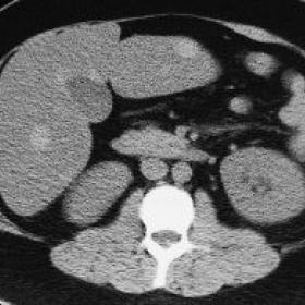CT scan of the liver