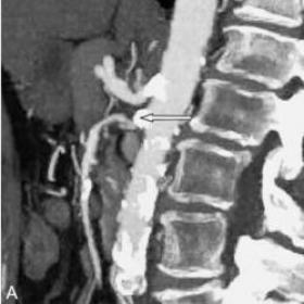 Contrast-enhanced CT scan of the abdomen