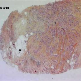 Invasive ductal carcinoma in a fatty breast