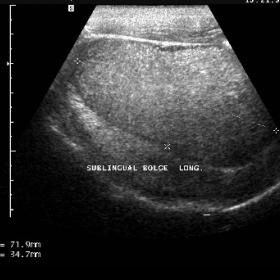 Ultrasound image of the dermoid cyst