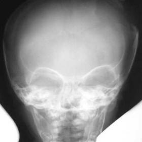 Skull X-ray 7 weeks after trauma