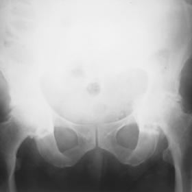 Pelvic radiograph of both hips