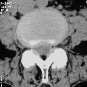 CT axial images at the L3-L4 level