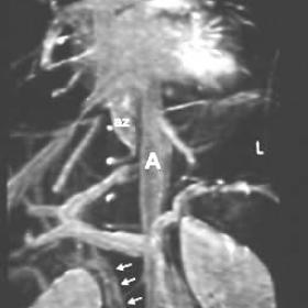 Coronal MR angiography of the IVC