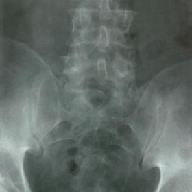 Plain radiographs of the lumbosacral spine