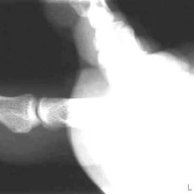 Radiograph of the great toe