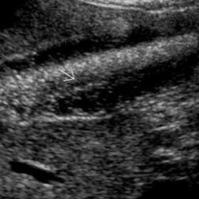 Image of the gallbladder